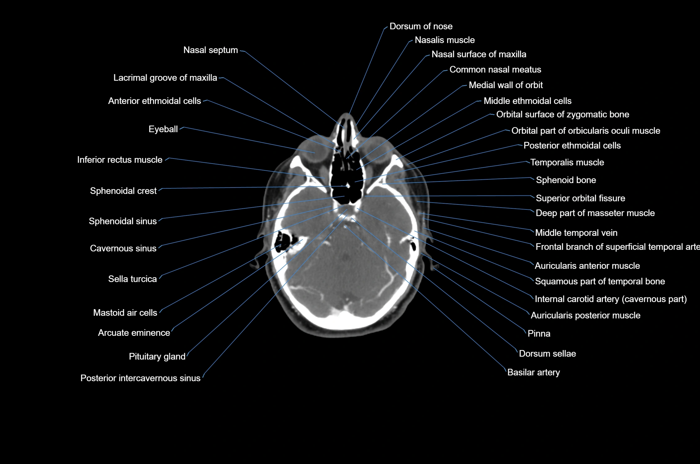 CT Neck axial cross sectional anatomy radiology image-img-00001-00009.webp